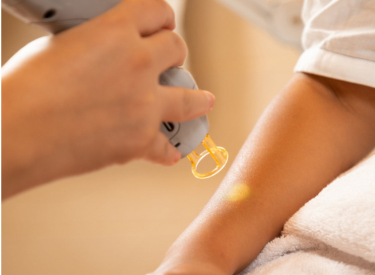 제모레이저 시술중인 환자 원주 원더스 피부과 