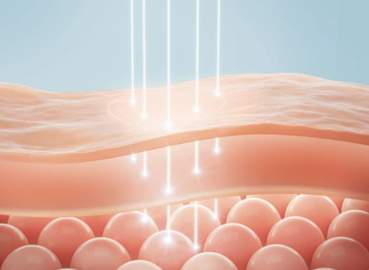 고주파, 초음파 프락셔널 장비의 컴비네이션으로 눈가에 활력을 주는 원주피부과 원더스의원의  시술
