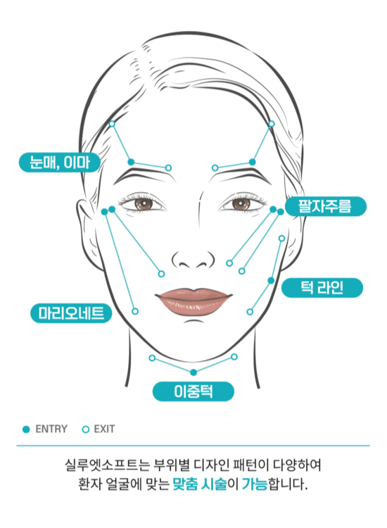 실루엣소프트 시술가능 부위: 턱라인 마리오넷 이중턱 팔자주름 눈매 이마 원주피부과 원더스의원