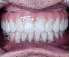 2024.02.29 최종 보철