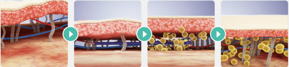 잼버실리프팅 시술후 효과가 나타나는 기전 원주피부과 원더스의원