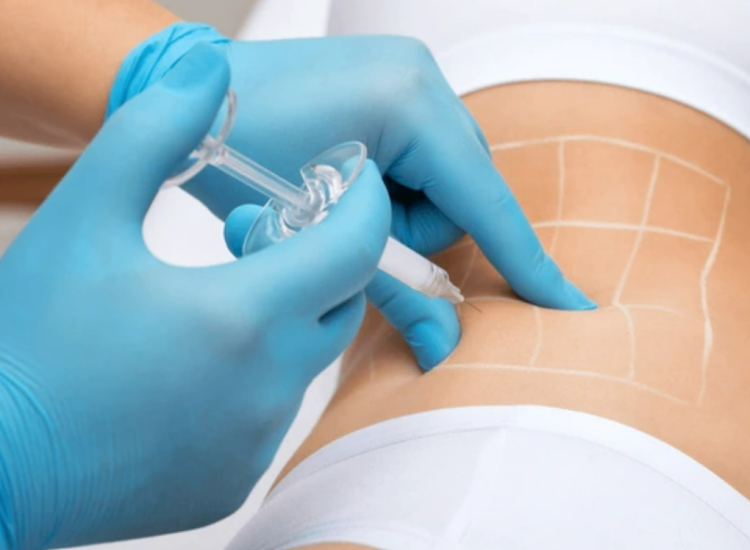 옆구리에 바디조각주사 시술중인 모습