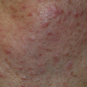 lvemectin 크림<br>(수란트라)