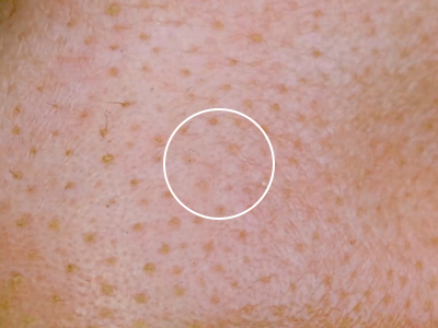 사람의 피부를 확대한 사진입니다. 사진 중앙에 내부가 비어있는 동그라미가 있습니다.