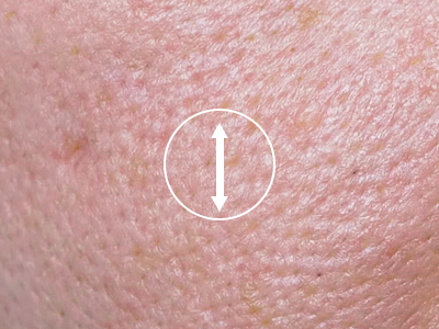 사람의 피부를 확대한 사진입니다. 사진 중앙에 화살표가 위아래로 뻗어있습니다.