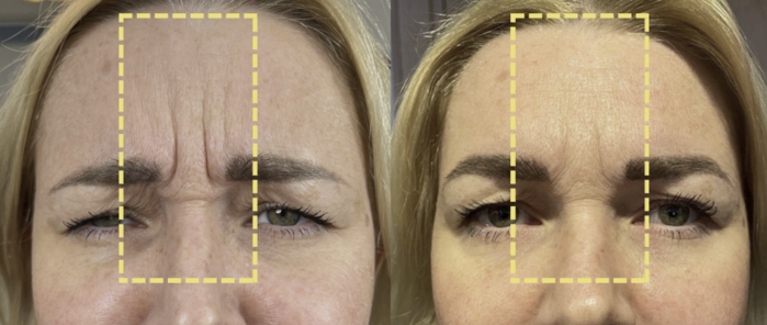 botox and glutathione Botox for Pain | Neuron Medical Corporation main image 1