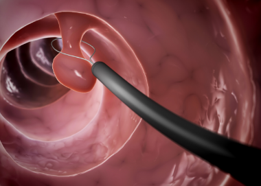 <alt=내시경치료>