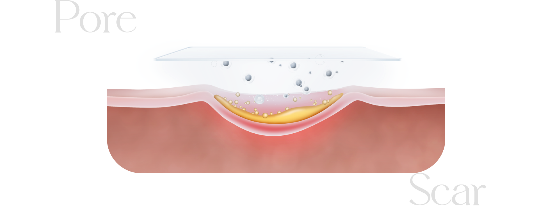 패인 흉터, 모공을 형상화한 이미지입니다. 반구 형태로 얕게 구멍이 파져 있고, 그 구멍에는 노란색 액체가 채워져있습니다. 노락색 액체 위로 회색 형태의 구슬들이 떠오르고 위에는 유리 형태의 사각형이 있습니다.
