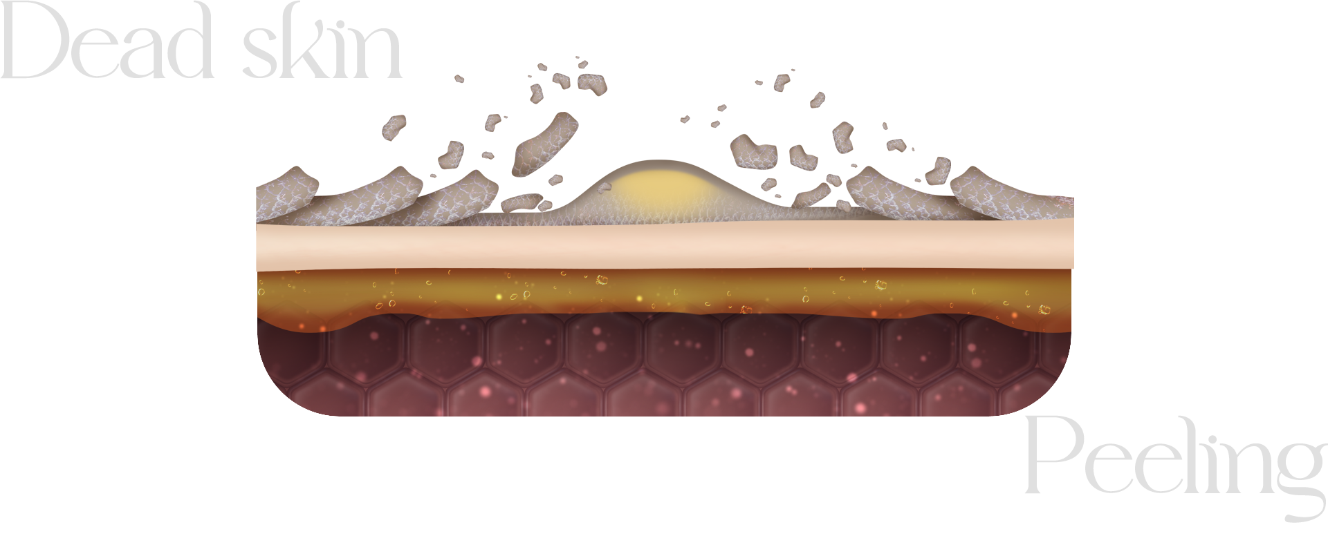 각질들이 모공을 막고 있는 모습