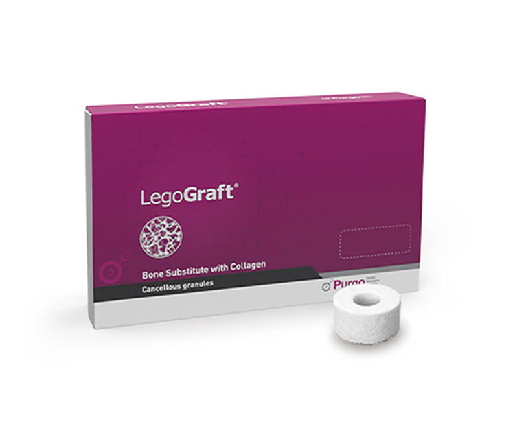 오산치과 서울수려한치과 푸르고 LegoGraft 이종골
