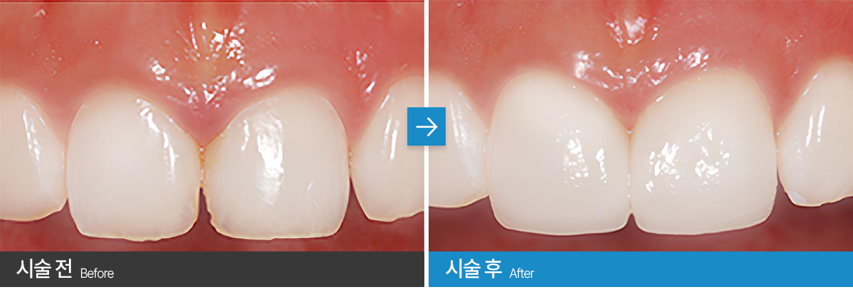 서울수려한치과 무삭제라미네이트 사례1