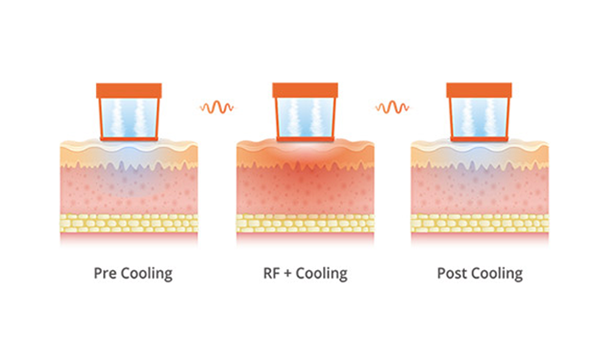 피부층과 올리지오 리프팅 전용팁의 이미지 3개가 일렬로 나란히 배치되어 있습니다. 좌측은 Pre Cooling, 중앙은 RF+Cooling, 우측은 Post Cooling 팁입니다. 각 팁 별로 어떻게 시술이 이뤄지는 표현하고 있습니다.