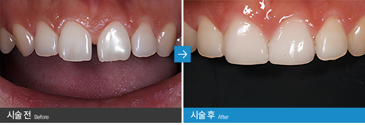 오산치과 서울수려한치과 무삭제라미네이트 사례2