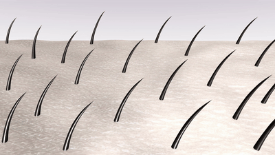 아포지 엘리트 플러스 레이저가 피부에 난 털들을 제거하고 있다.