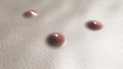 피부에 있는 점과 비립종을 표현한 이미지입니다.