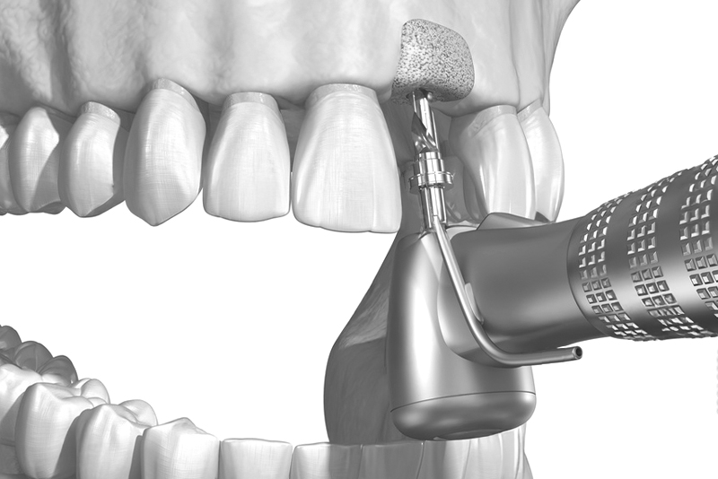 오정구-삼정동-연세미소애치과-상악동거상술-자가진단