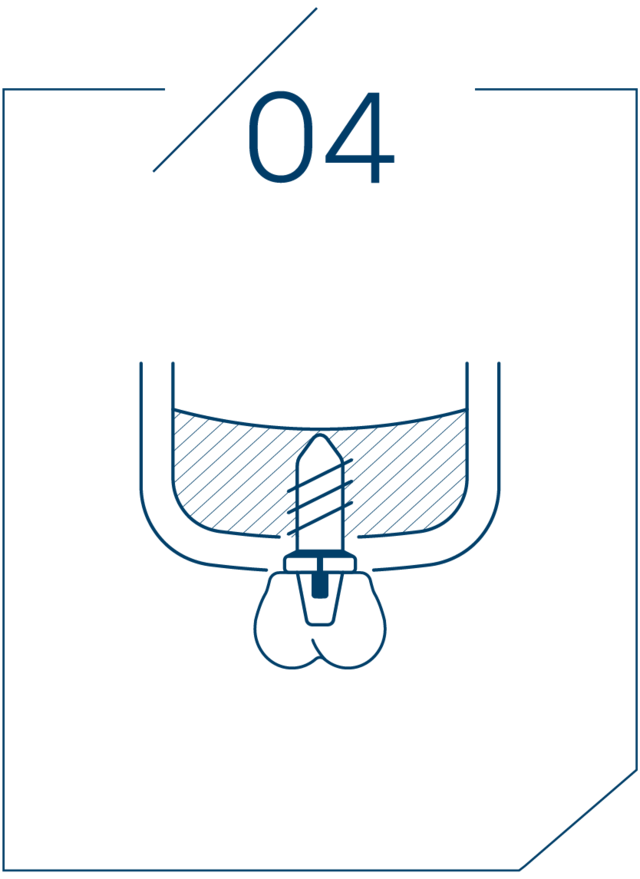 <strong>4단계 임플란트 식립</strong>