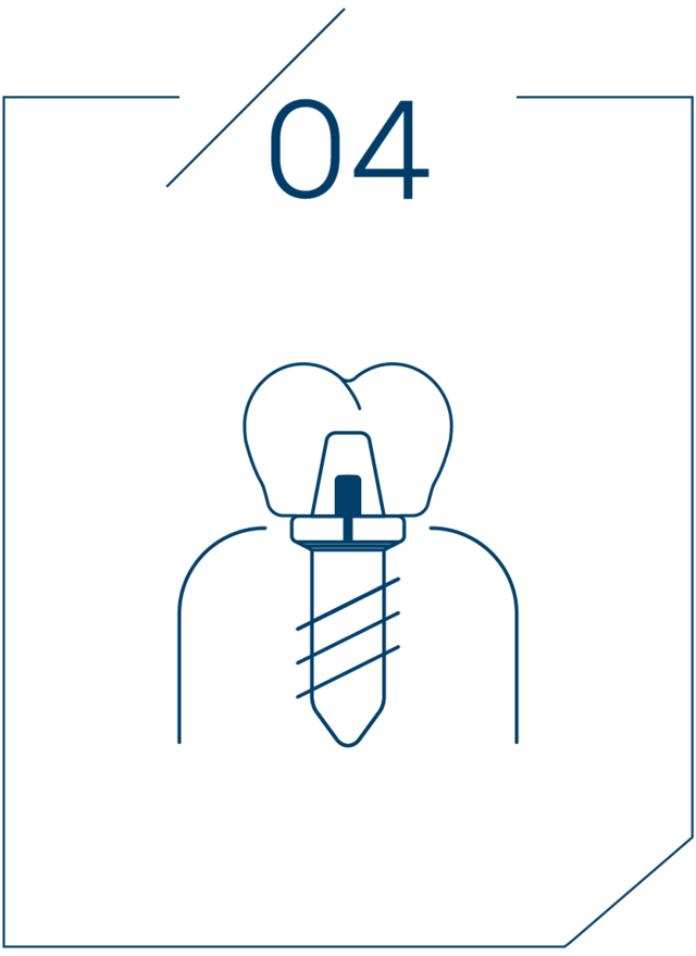 <strong>4단계 보철물 결합</strong>