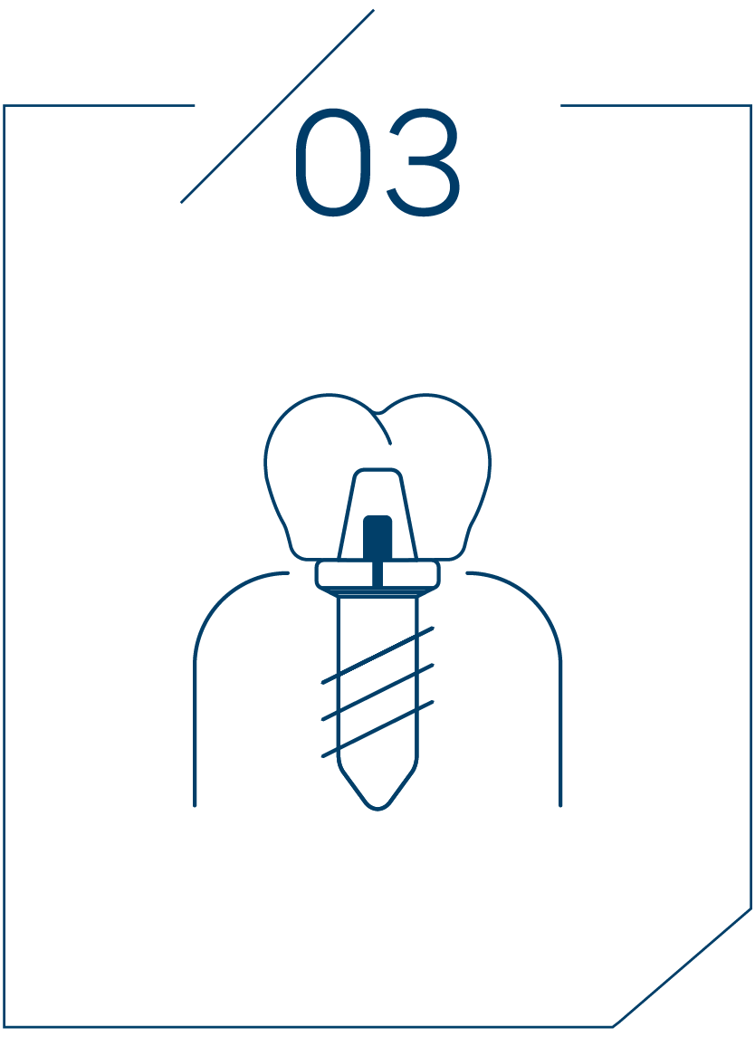 <strong>3단계 임플란트 식립</strong>
