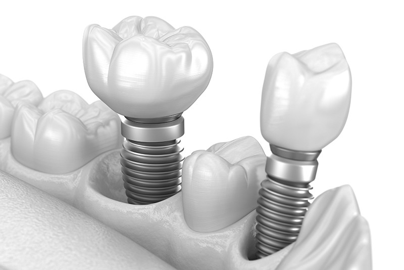 부천-연세미소애치과-임플란트-심미임플란트