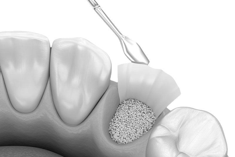 오정구-삼정동-연세미소애치과-치조골이식술-자가진단