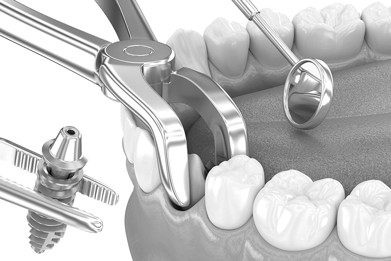 오정구-삼정동-연세미소애치과-발치후즉시식립-자가진단