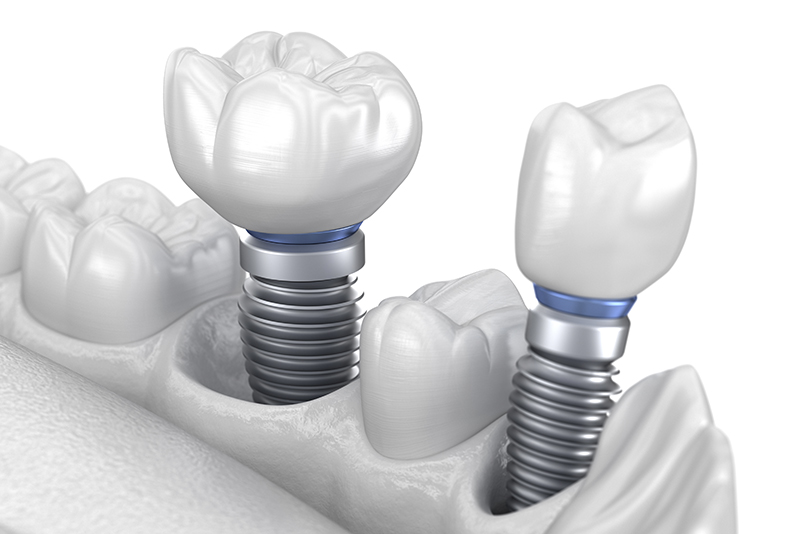 부천-연세미소애치과-임플란트센터-심미임플란트