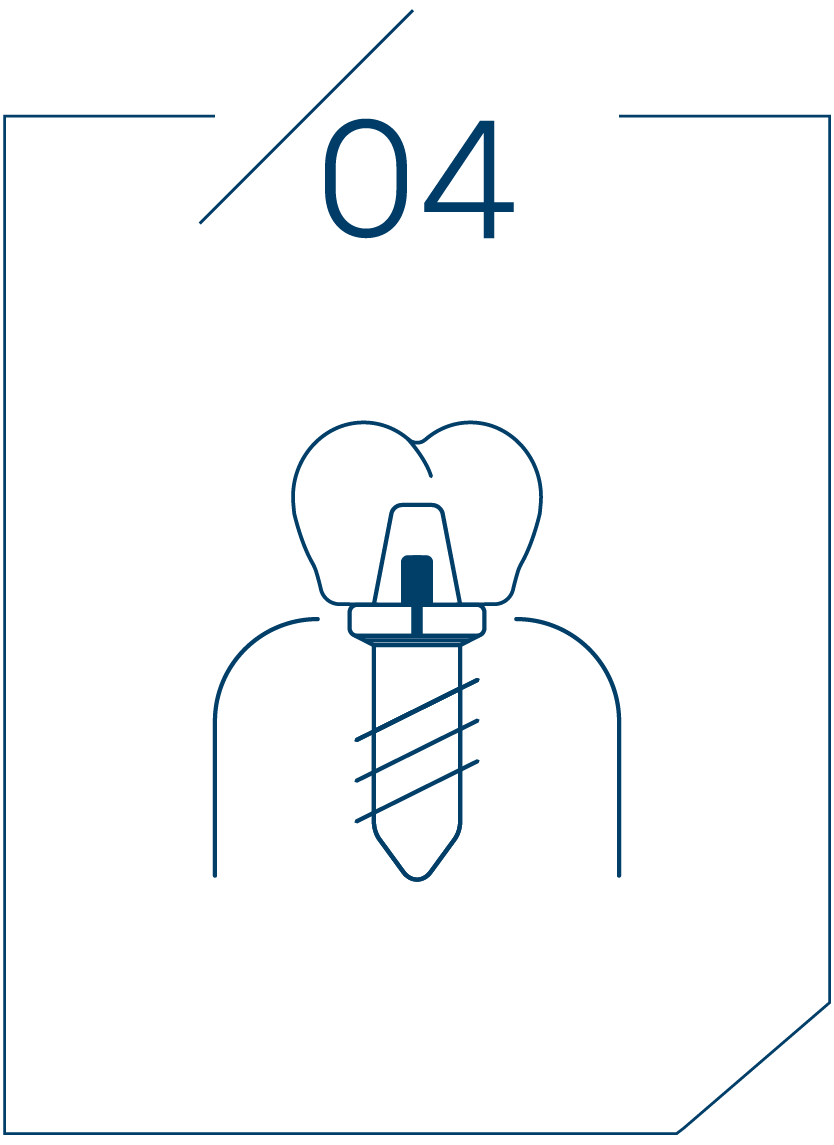 <strong>4단계 보철물 결합</strong>