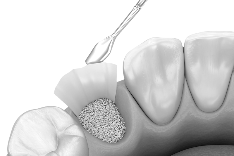 오정구-삼정동-연세미소애치과-치조골이식술-자가진단