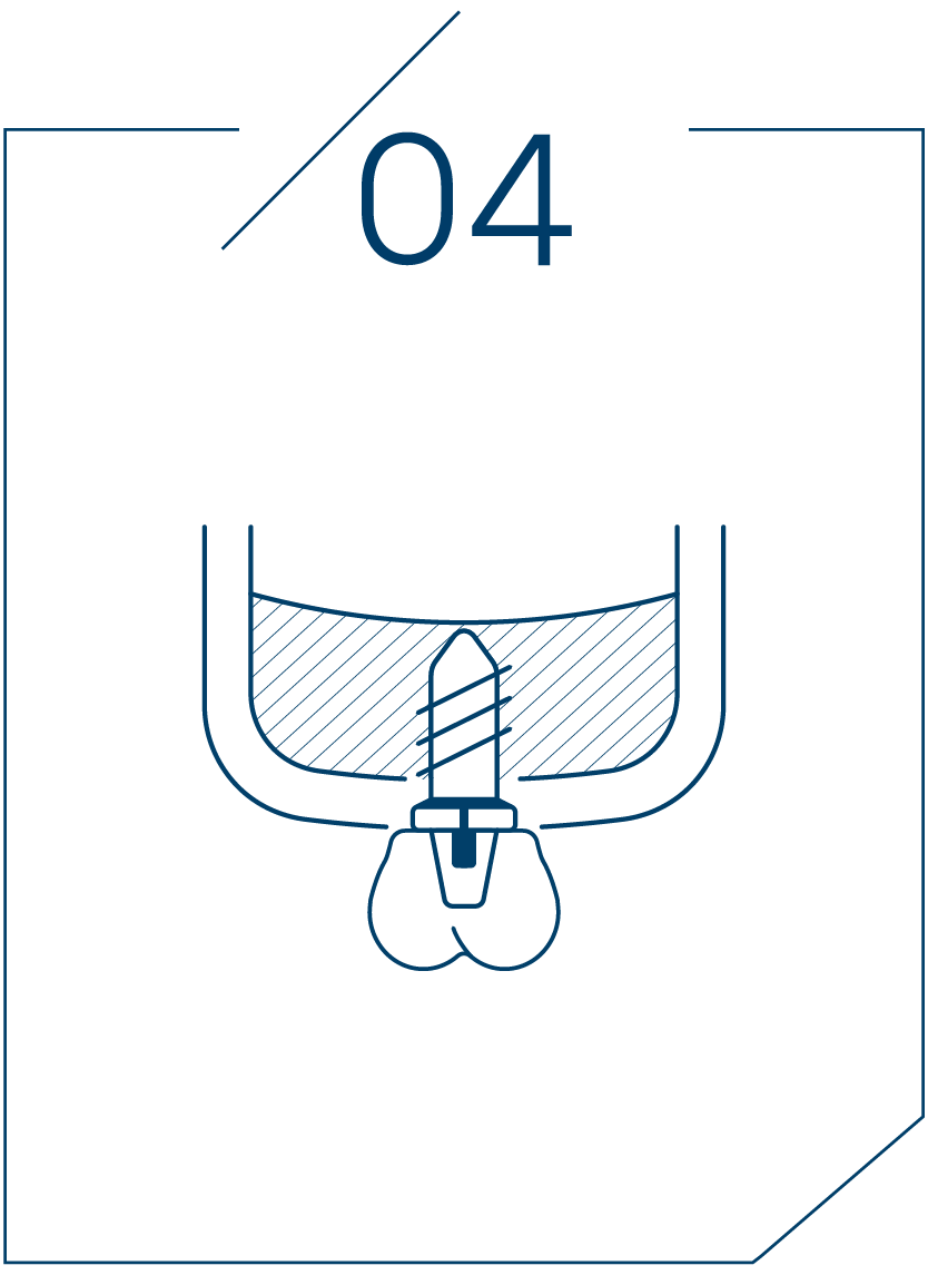 <strong>4단계 임플란트 식립</strong>