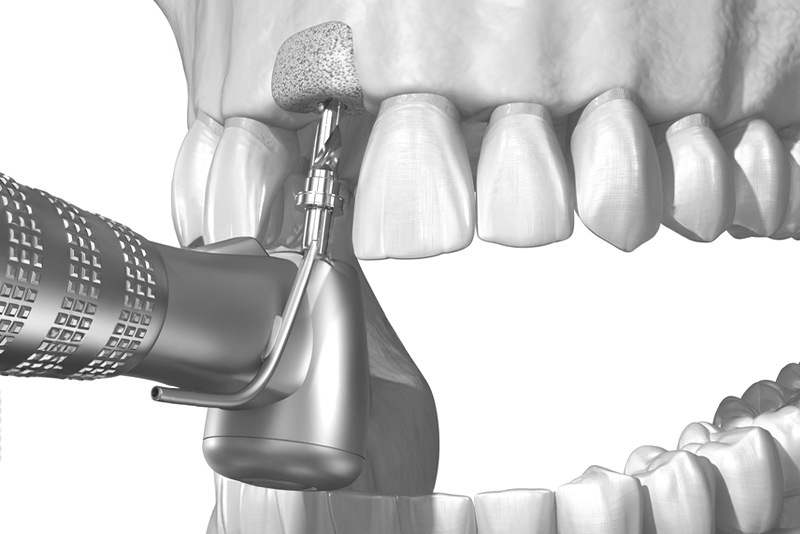 오정구-삼정동-연세미소애치과-상악동거상술-자가진단