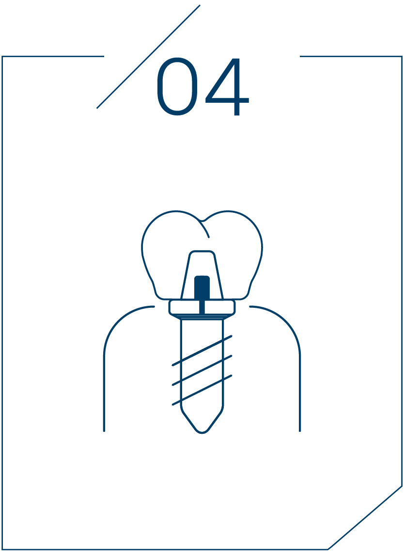 <strong>4단계 보철물 결합</strong>