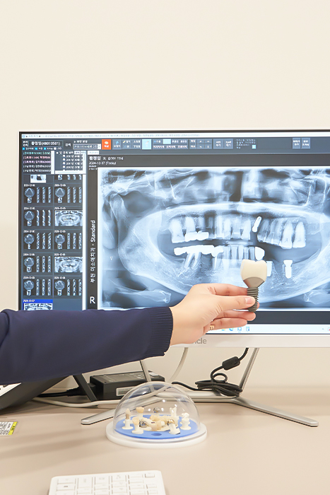 오정구-삼정동-연세미소애치과-임플란트센터-발치후즉시식립-임플란트모형