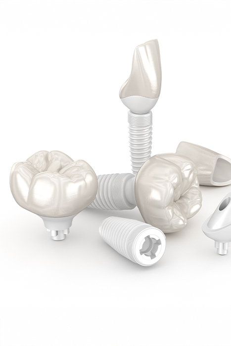 오정구-삼정동-연세미소애치과-임플란트센터-임플란트모형