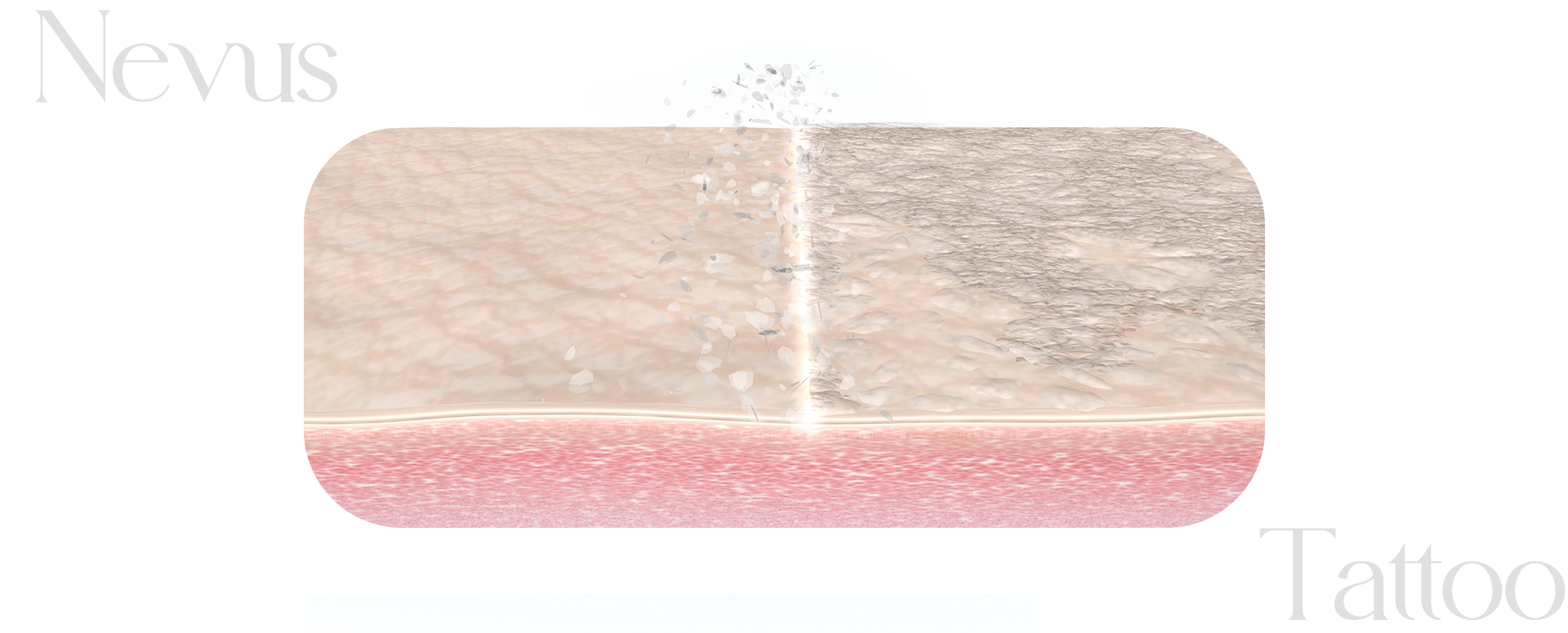피부층을 표현한 이미지입니다. 중앙에 흰색 레이저가 있으며 좌측은 깨끗한 피부, 우측은 검은 색소가 쌓여 있는 피부입니다. 중앙의 흰색 레이저로 인해 검은 색소가 사라지고 있는 모습입니다.