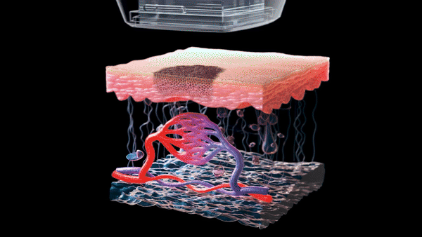 리팟레이저 시술 시연 이미지