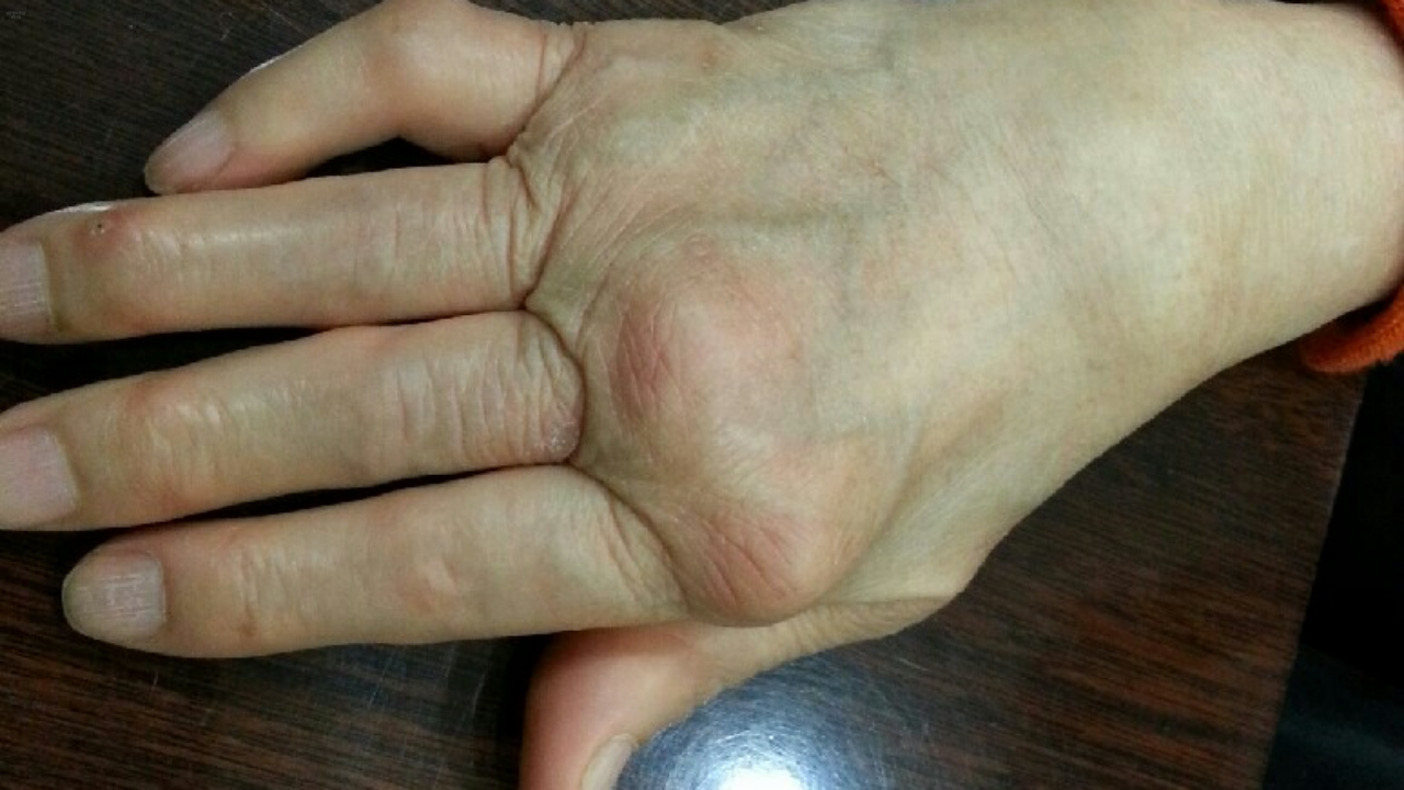 말기