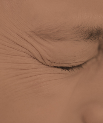 <p style="font-weight: 700;">잔주름 <span class="mobile_textBreak">제거</span></p>
