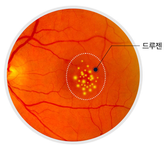 드루젠 예시 이미지