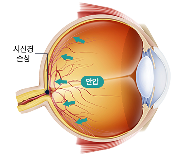 녹내장이 생기는 이유