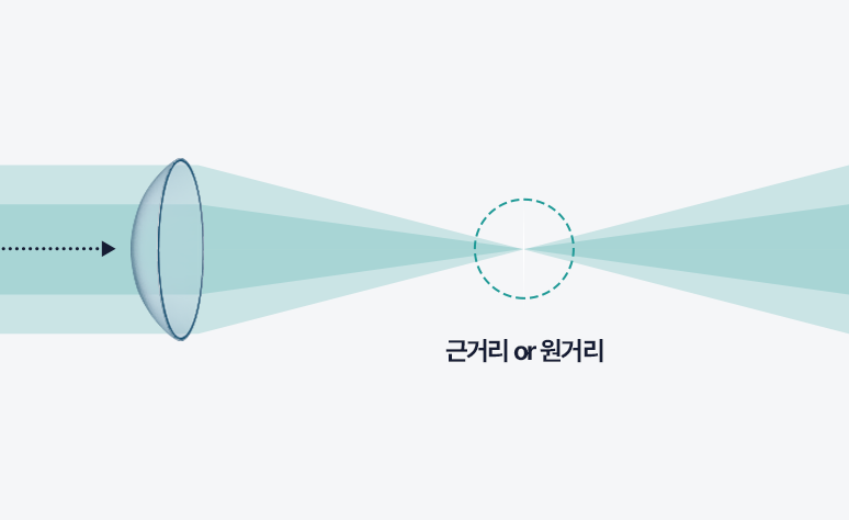 단초점 인공수정체의 작동 예시