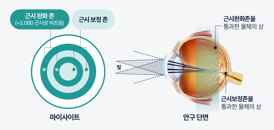 마이사이트의 시력교정 원리