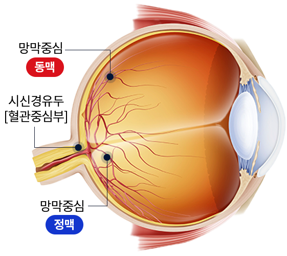 혈압 상승으로 인해 망막혈관폐쇄가 어떻게 생겨나는지 설명