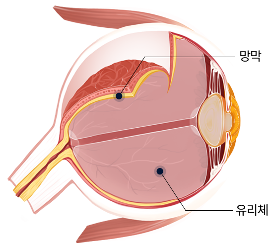 망막과 유리체