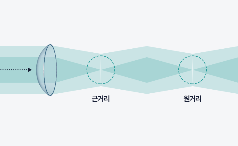다초점 인공 수정체 예시