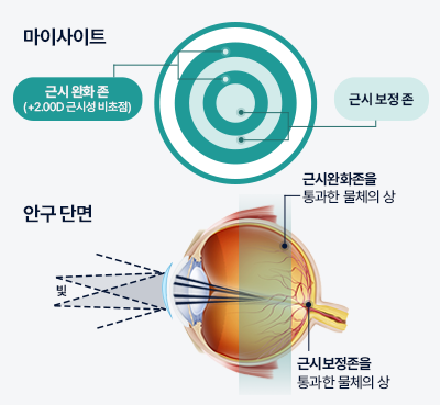 마이사이트의 교정 원리