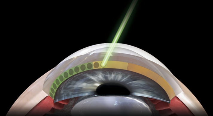 레이저 치료 포인트 1