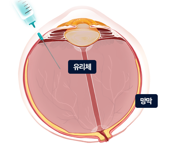 안구 내 주사 시술방법 묘사