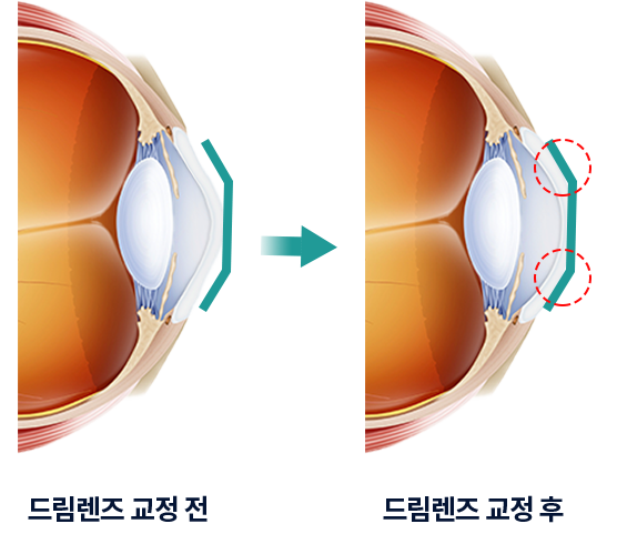 드림렌즈 교정 전후