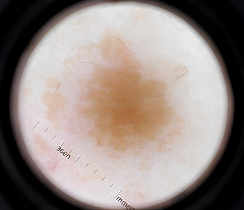 Dermascope 확대 모습